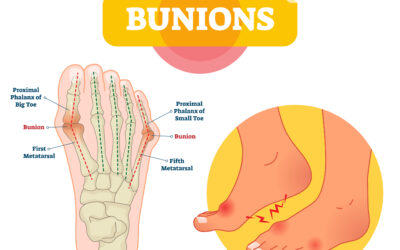 Can Bunions Go Away on Their Own? Separating Fact from Fiction