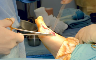 Bunion Surgery Alternatives That Work: How to Avoid Surgery