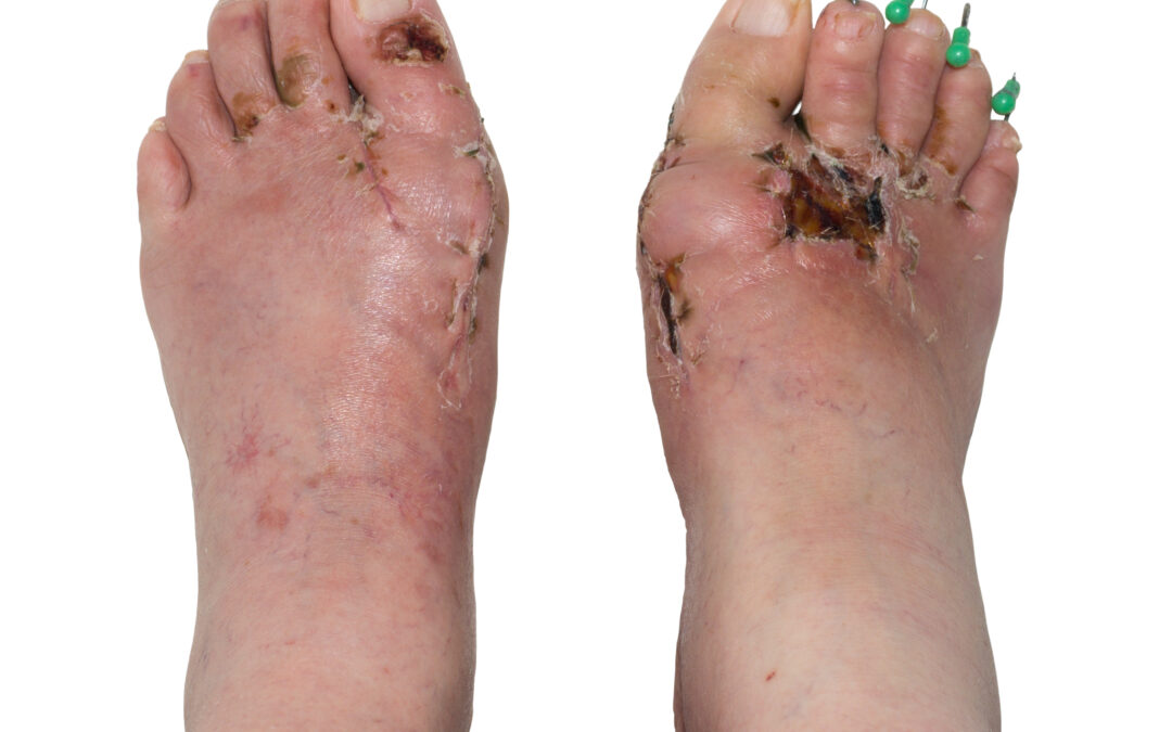Is Bunion Surgery Worth It? What You Need to Know