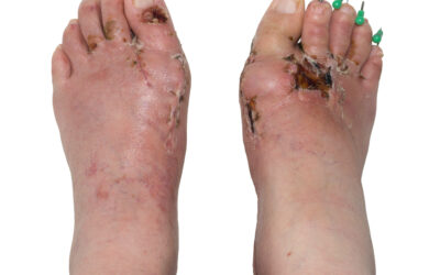 Is Bunion Surgery Worth It? What You Need to Know